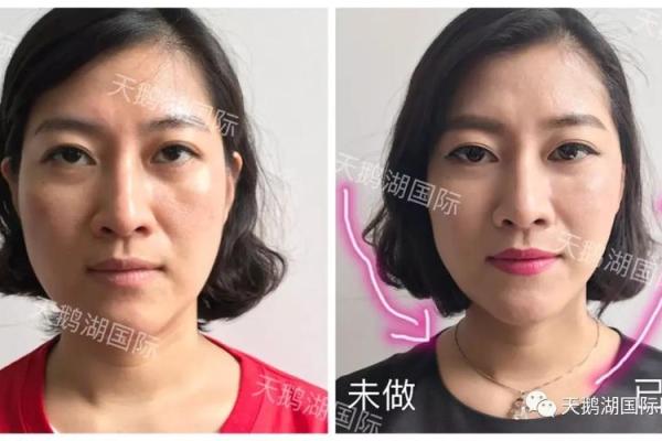 如何优化八字型下巴？