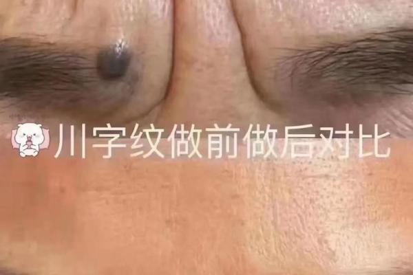 川字纹几种类型，一定要了解清楚：悬针纹、八字纹、双雀纹