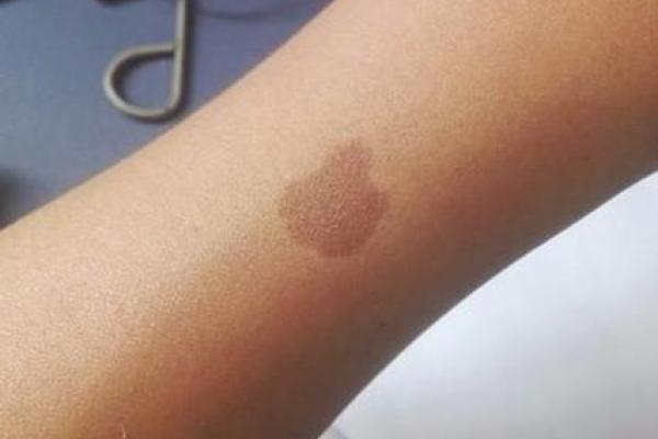 身体上的胎记位置不同算命分析