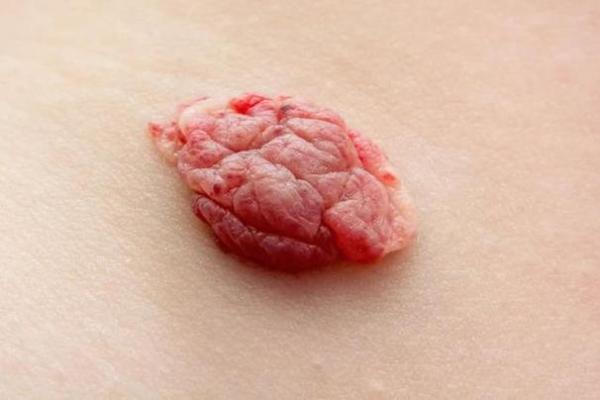 身体上的胎记位置不同算命分析