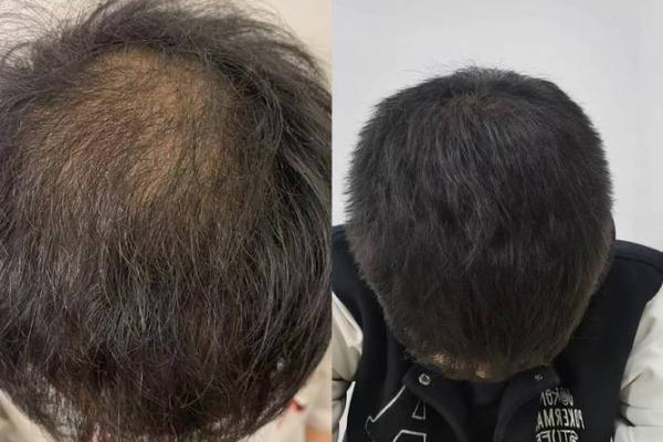 头发稀少的八字特征 八字头发稀少