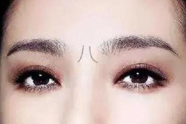 眉间八字纹消除